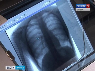В калужских торговых центрах разместят мобильные флюорографы