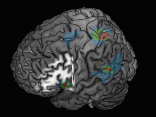 Подсвеченные участки мозга задействованы в создании различного рода "сверхъестественных" иллюзий и галлюционаций (иллюстрация Blanke et al/EPFL). 