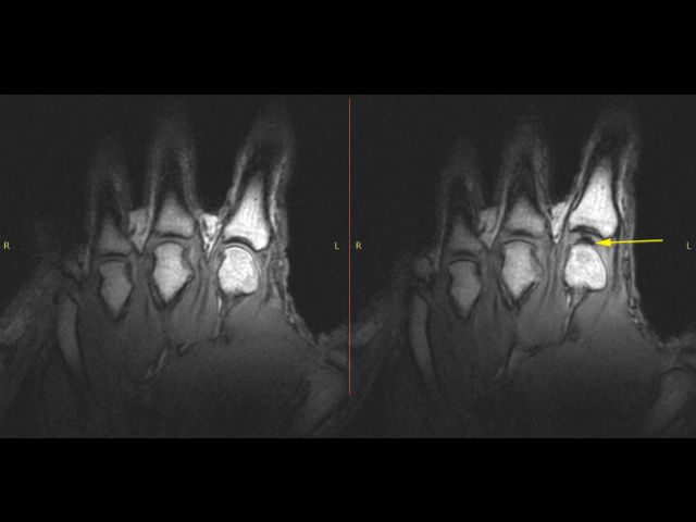 Изображение сустава до (слева) и после (справа) потягивания за палец. Видно образовавшуюся тёмную внутрисуставную полость, возникающую вместе со щелчком (фото University of Alberta).