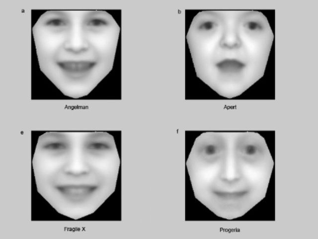 Модельное изображение лица ребёнка с редкими генетическими нарушениями: по часовой стрелке синдром Ангельмана, синдром Аперта, прогерия и синдром хрупкой Х-хромосомы (иллюстрация Khristoffer Nellaker/ University of Oxford).